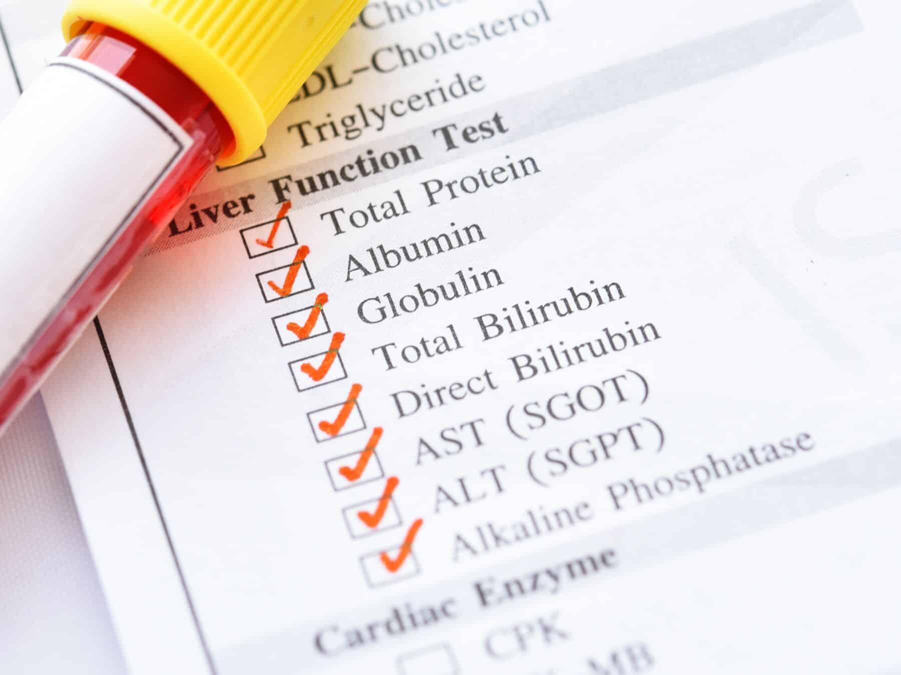 Does A Liver Function Test Show Cirrhosis