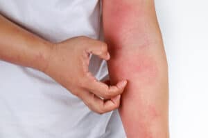 closeup of person scratching rash on arm
