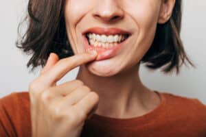 woman holding lip down to show teeth