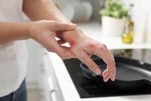 Woman with burn on her hand